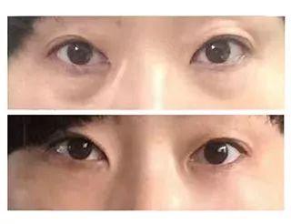 去眼袋的视频,跟随去眼袋视频轻松恢复明眸神采